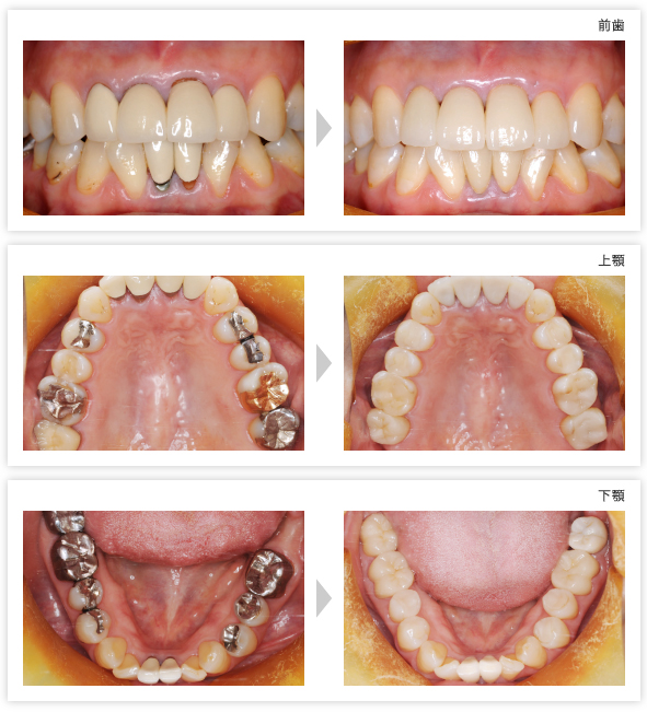 Before-After