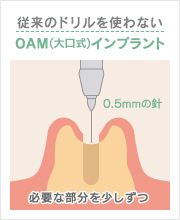 従来のドリルを使わないOAM(大口式)インプラント