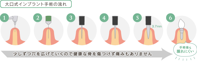 少しずつ穴を広げていくので健康な骨を傷つけず痛みもありません